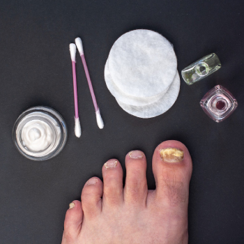 Ingrown Toenails in Fort Myers & Cape Coral, FL